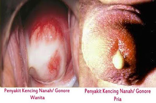 Illustration for article titled Sakit saat kencing
dan keluar cairan putih